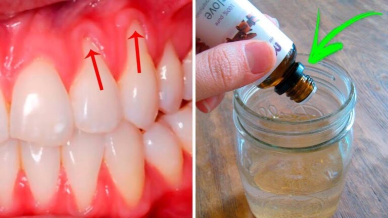 This simple remedy transforms receding gums naturally… discover a stunning smile today!