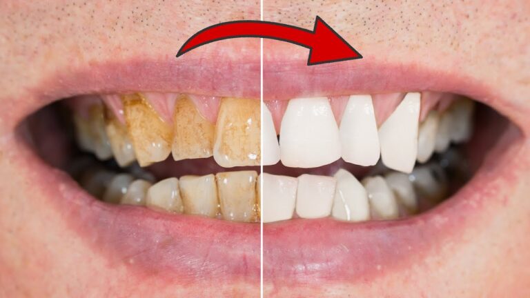 Whiten Your Teeth in 2 Minutes: 5 Easy Tips for a Dazzling Smile!