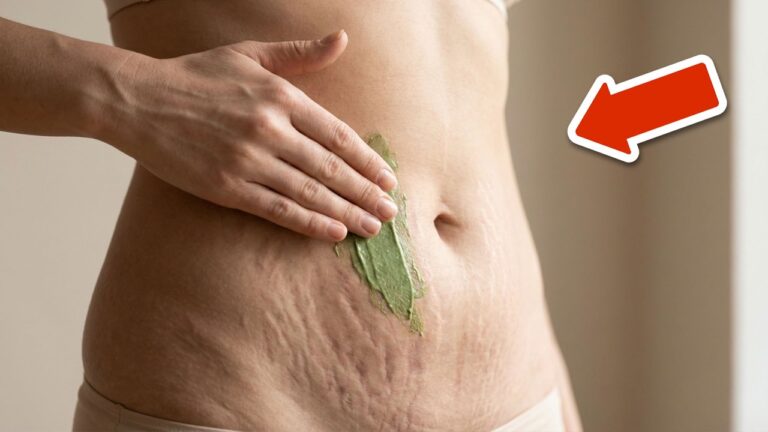 Remove Stretch Marks Fast: 5 Powerful Tips You Need to Try Now!