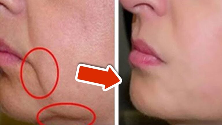 Remove 5 Types of Mouth Corner Wrinkles Quickly and Effortlessly!