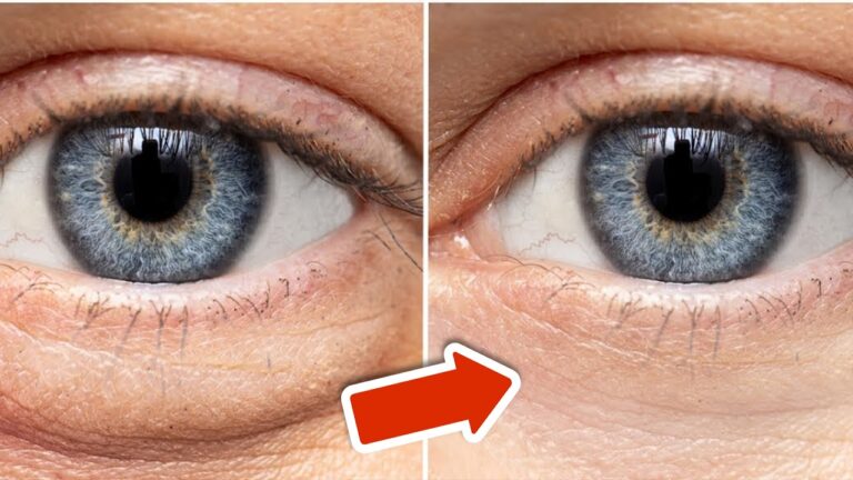 Remove Puffy Eyes in 20 Minutes with This Simple Trick You Need to Try!