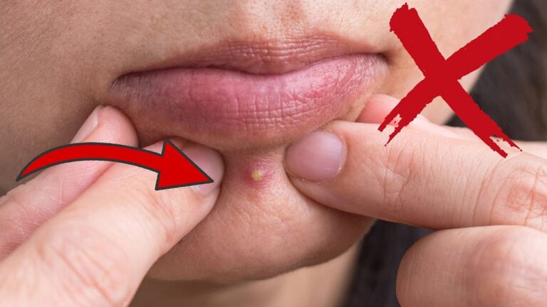 7 Spots Where Popping a Pimple Could Be Life-Threatening! Discover the Risks!