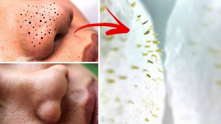 Remove 7 Blackheads Fast with This Incredible Trick! 💥✨
