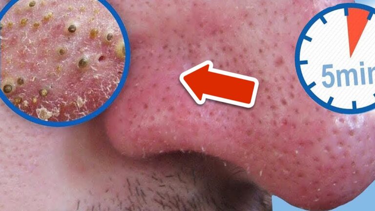 Remove 7 Blackheads Fast with This Incredible Hack! 💥