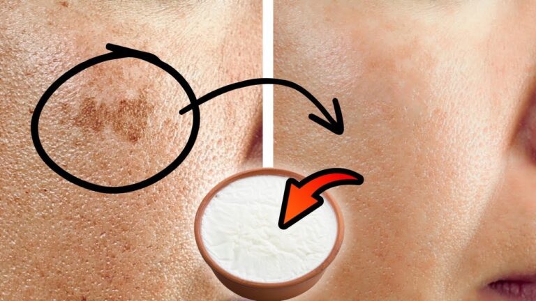 5 Simple Kitchen Ingredients to Remove Age Spots Naturally