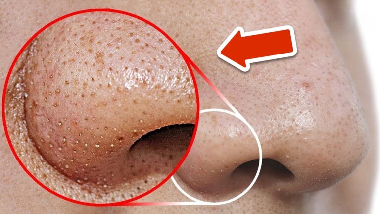 5 Steps to Quickly Remove Blackheads from Your Nose with This Secret Trick!