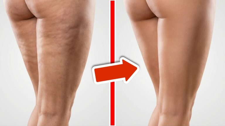 6 Quick Tips to Banish Cellulite Fast and Boost Your Confidence!